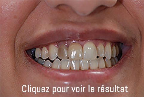 dents avant intervention